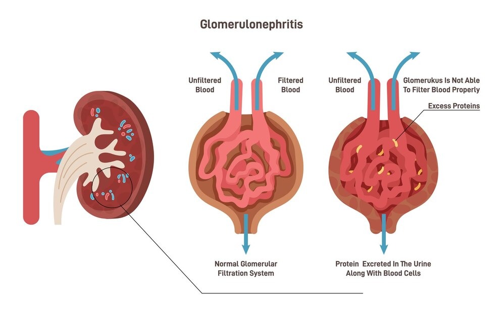 Glomerulonephritis treatment in Faridabad